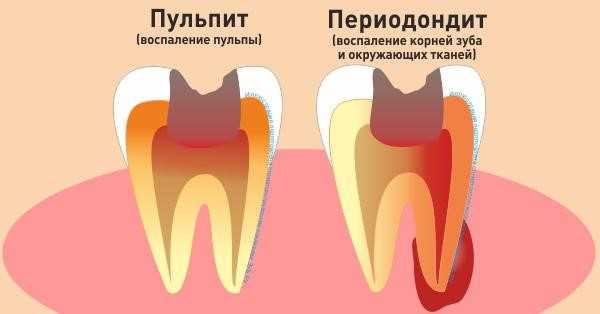 Почему возникает пульпит зуба