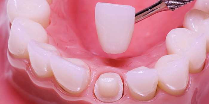 Как лучше восстановить депульпированный зуб?