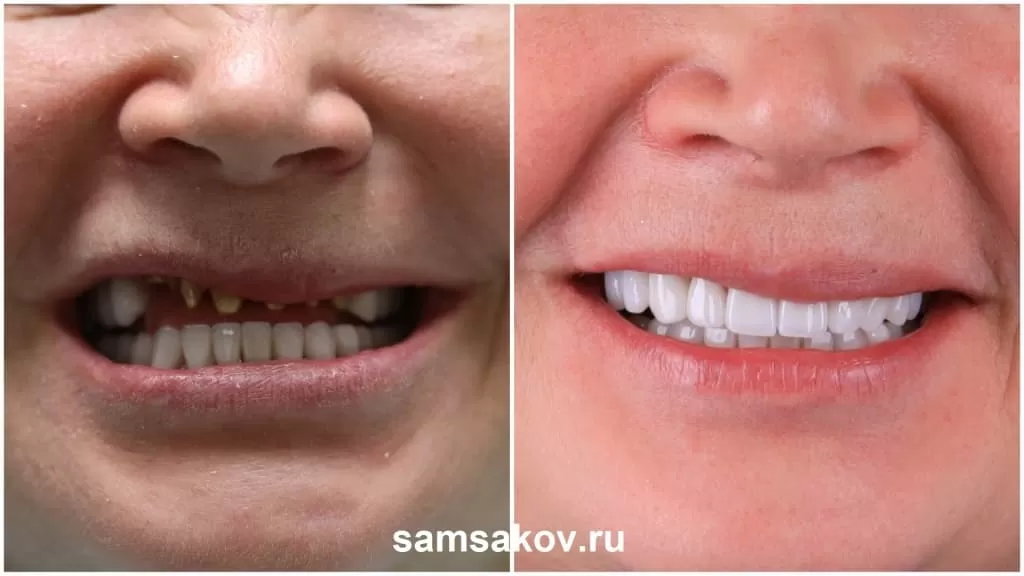Зубные коронки в «Зубном стандарте»