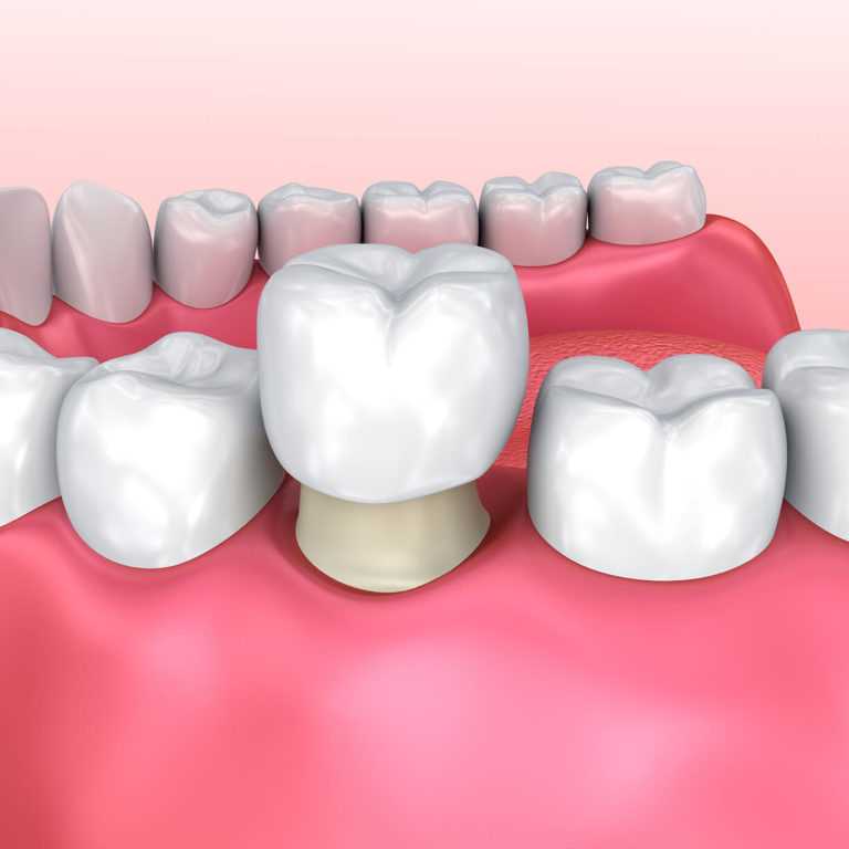 Зубные коронки для восстановления четырех зубов