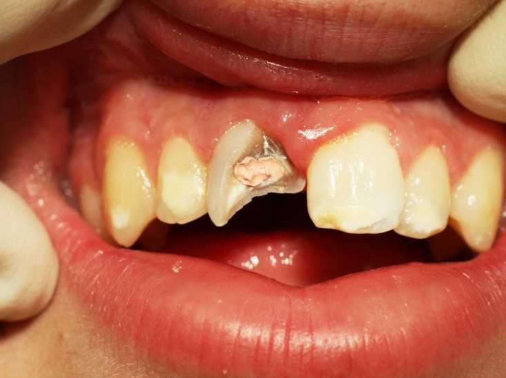 Способы восстановления сломанного зуба