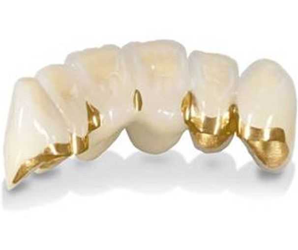 Коронки зубные золото