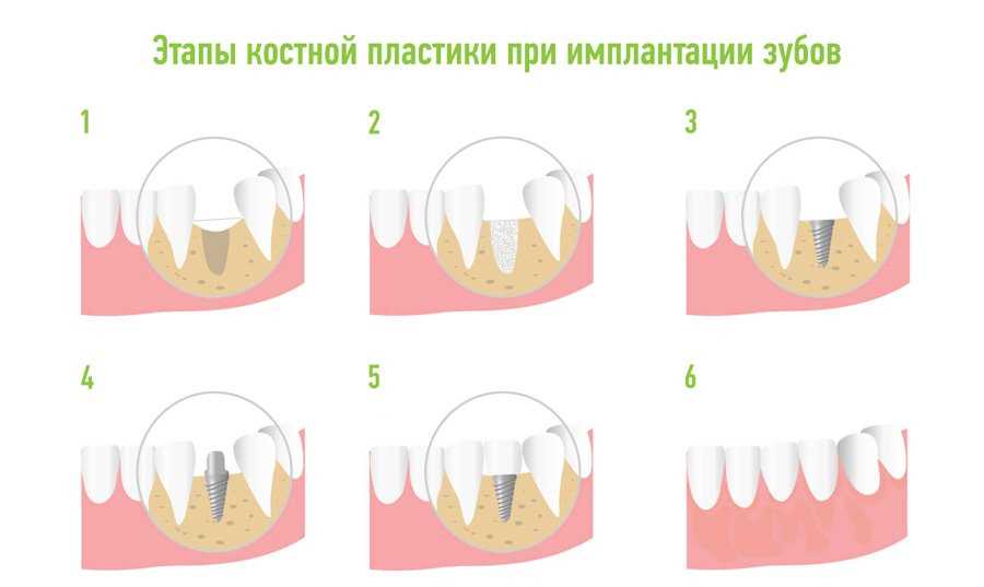 Разновидности костной пластики для имплантации зубов