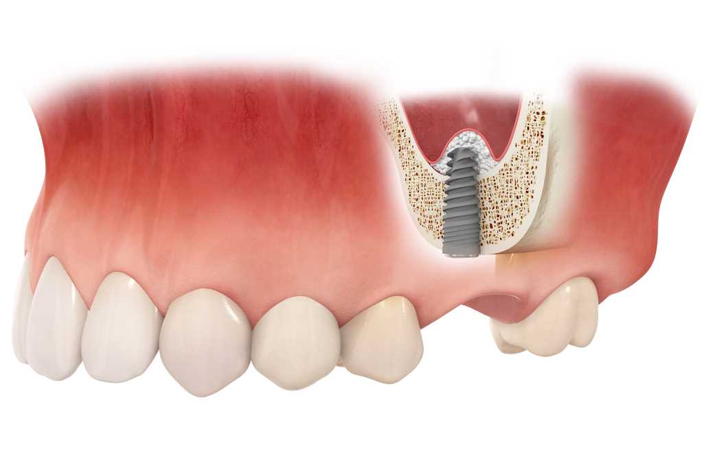 Костное протезирование зубов