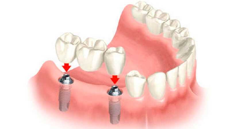 Красивые зубы – комплексное протезирование