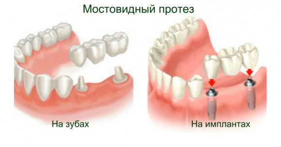 Крепление зубных коронок
