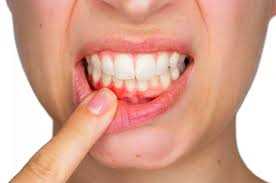 Кровоточат десна — эффективное лечение в домашних условиях без похода к стоматологу