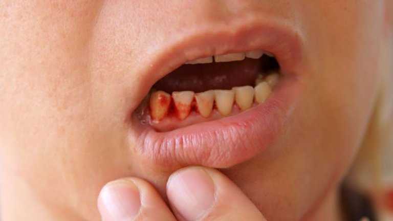 Лечение кровоточащих десен — эффективные методы и рекомендации от стоматолога