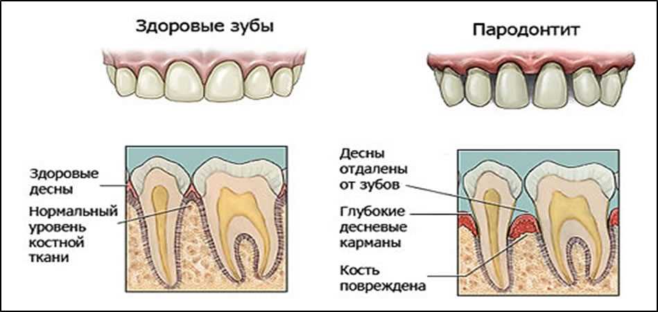 Народные методы лечения заболеваний зубов и десен