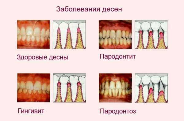 Профилактика заболеваний зубов и десен