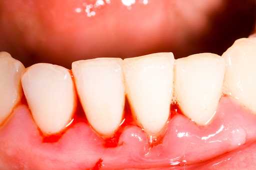 Лечение десен стоматологом