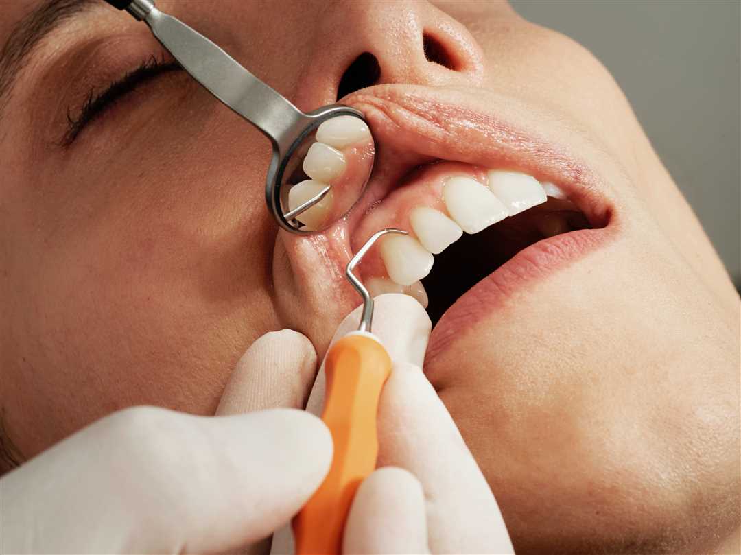Эффективные методы лечения десен — устранение воспаления, профилактика заболеваний и сохранение здоровья полости рта