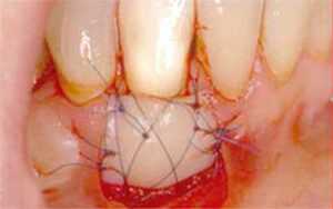 Рекомендации стоматолога-хирурга после имплантации зубов