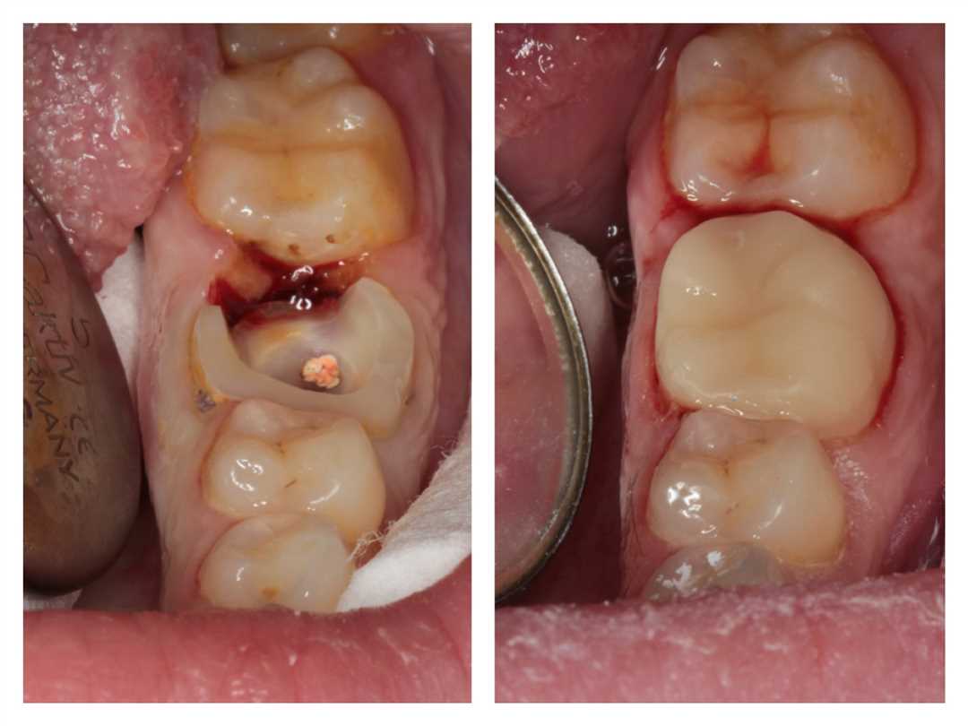 Новейшие методы комплексного лечения и профилактики всех стадий форм кариеса зубов без хирургического вмешательства