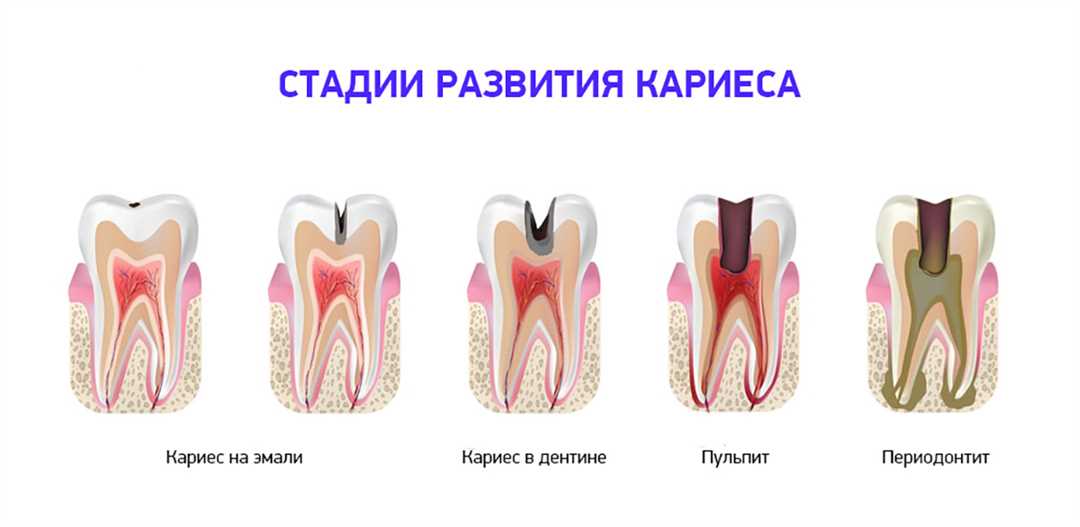 Стоимость лечения кариеса и восстановления 1 поверхности зуба: