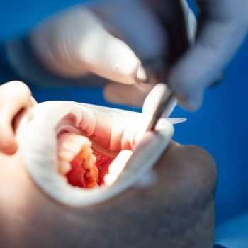 Восстановление 1 поверхности зуба при помощи пломбы