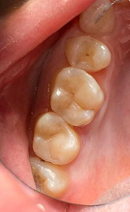 Лечение хронического кариеса 27 зуба