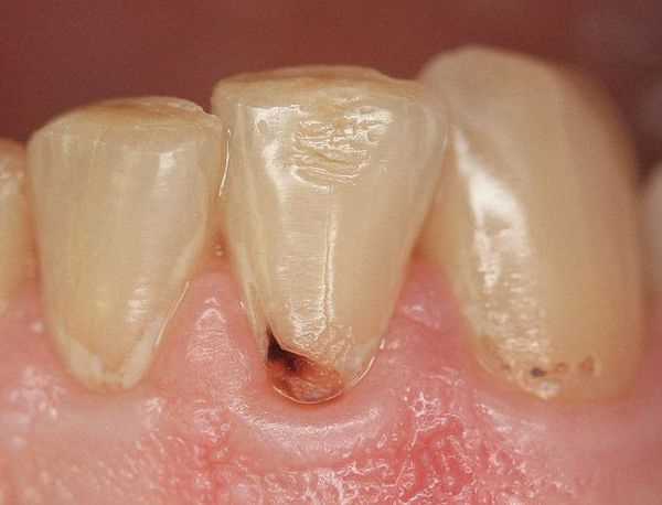 Реминерализующая терапия зубов в стоматологии Гарант