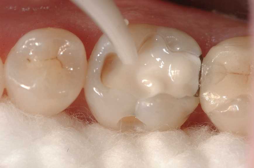 Лечение кариеса депульпированного зуба 4800