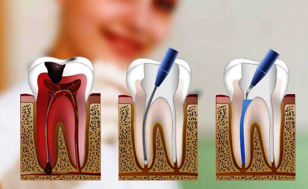 Как лечат вторичный кариес депульпированного зуба?