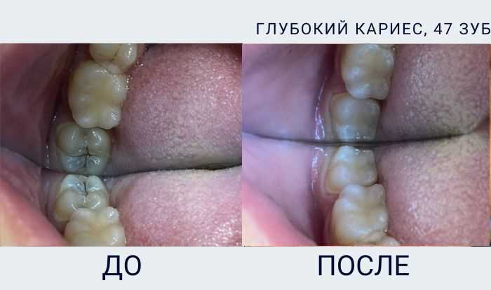 Лечение пародонтоза фото до и после