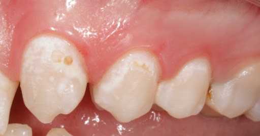 Как правильно лечить кариес эмали и сохранить здоровье зубов в долгие годы