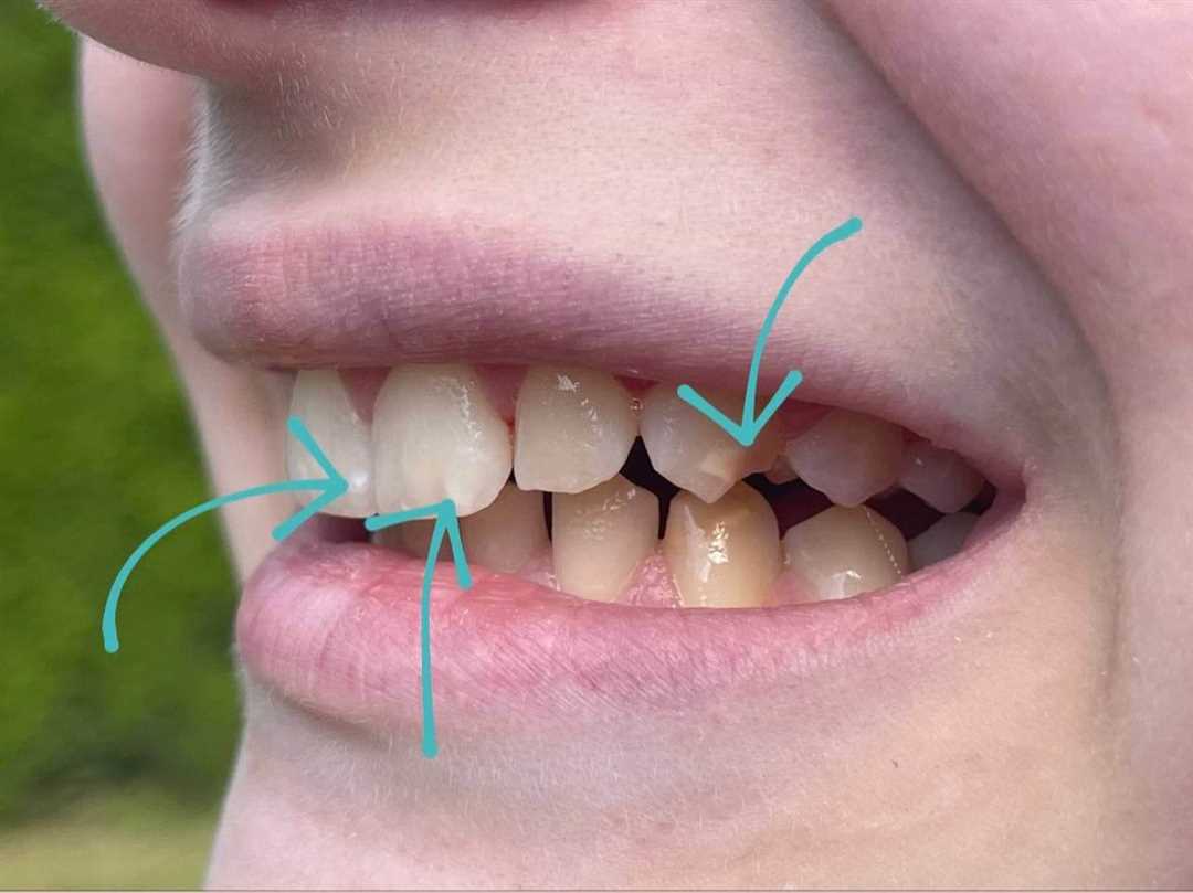 Лечение травм зубов