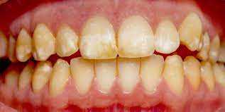 Причины гиперестезии зубов