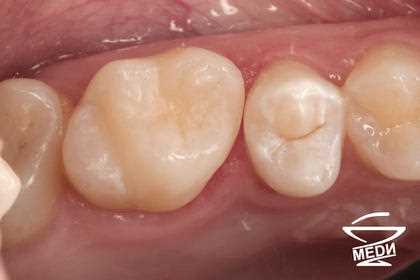 Кариес меди — эффективное лечение проблем зубов с использованием медицинских технологий