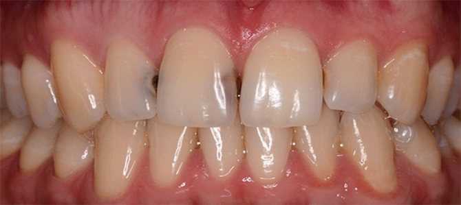 Эффективные и безболезненные методы лечения кариеса между зубами — прогрессивные подходы и инновационные технологии