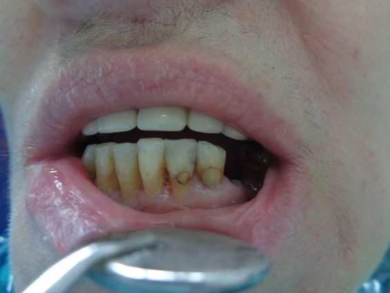 2. Лечение кариеса поверхностного зубов в Москве - это возможно!