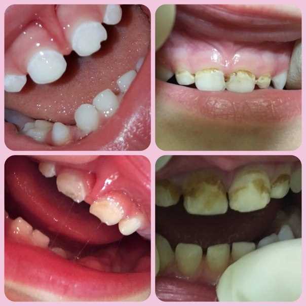 Как лечат зубы в 2–3 года