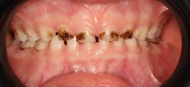 Серебрение — эффективное лечение кариеса для здоровых и красивых зубов