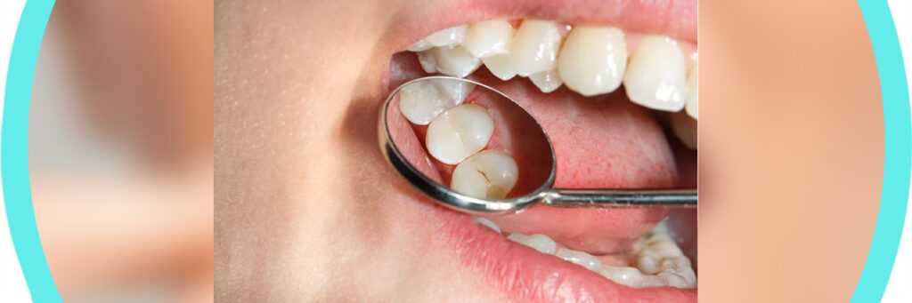 Методы и этапы лечения зубного кариеса