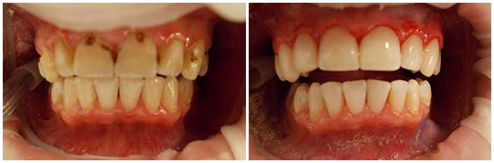 Световая пломба — инновационное лечение кариеса для здоровья зубов