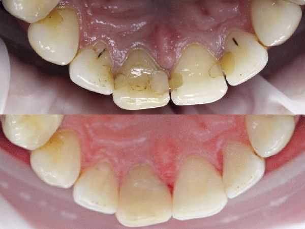 Терапевтическое лечение – залог здоровья зубов