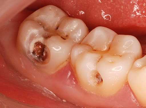 Надежное и эффективное лечение кариеса жевательных поверхностей для восстановления здоровья зубов и улучшения качества жизни