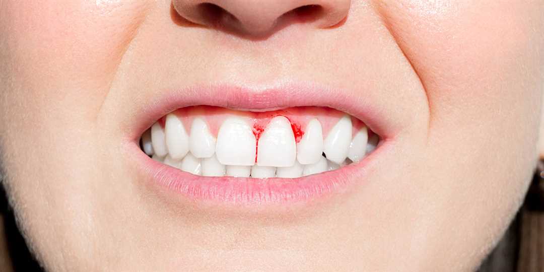 Зубная паста при кровоточивости десен