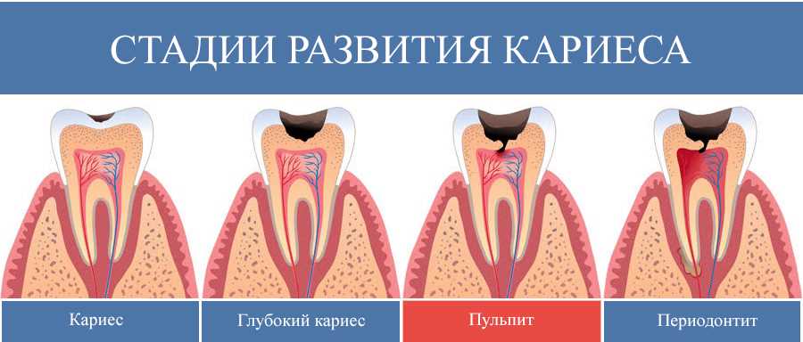 Как диагностируют воспаление нерва зуба