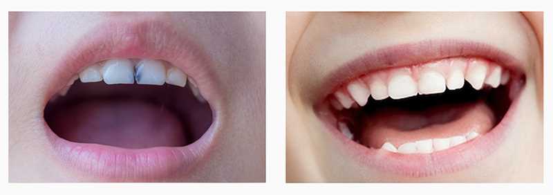 Лечение осложненного кариеса молочных зубов