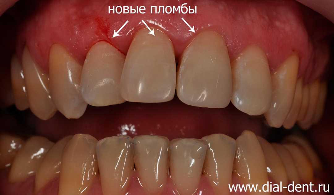 Как лечат кариес на передних зубах?