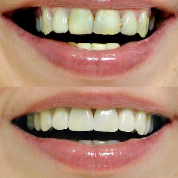 Причины кариеса передних зубов