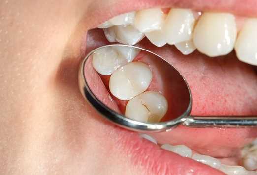 Эффективные методы лечения поверхностного кариеса для сохранения здоровья зубов и обеспечения стойкой защиты эмали