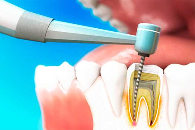 Лечение с удалением пульпы или зубы
