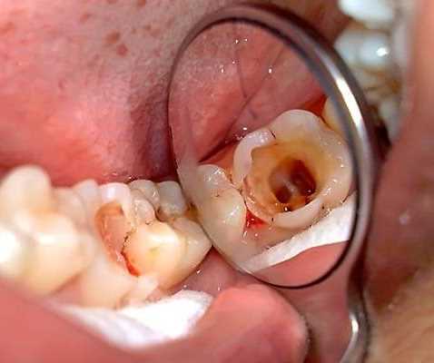 Что же это такое – пульпит зуба?