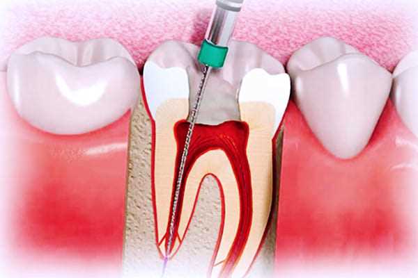 Как эффективно и безболезненно лечить пульпит г и избавиться от зубной боли — современные методы и технологии