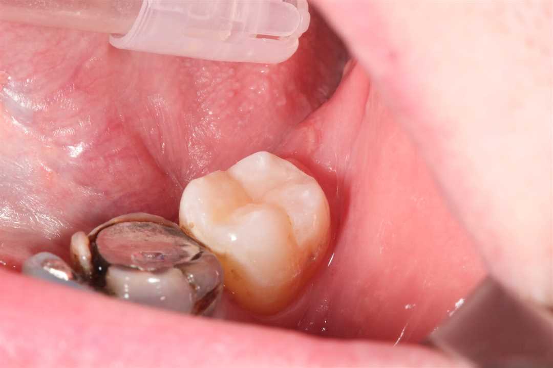 Лечение пульпита при помощи проникновения препаратов внутрь зуба