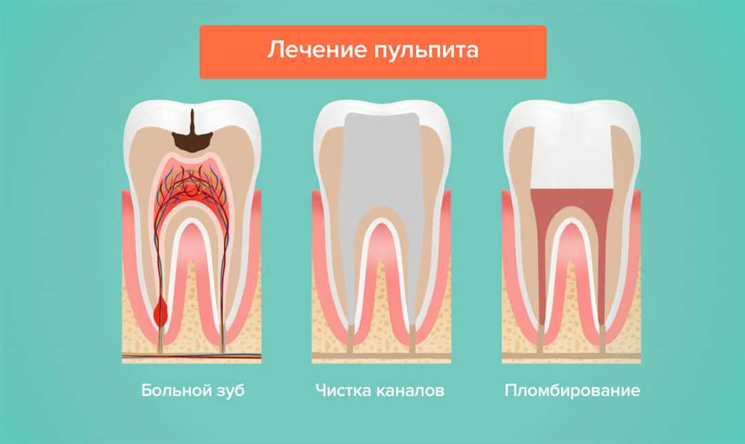 Лечение пульпита постоянных коренных зубов у детей