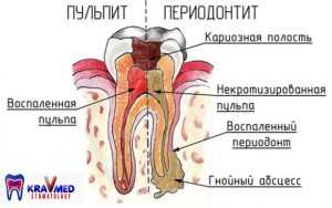 Лечение пульпита постоянных зубов