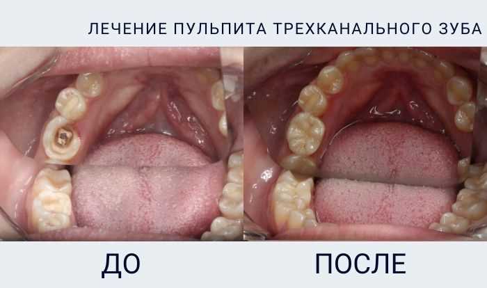 Болит ли зуб, когда в нем есть кариес?